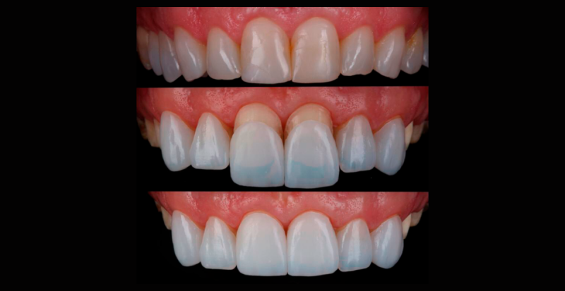 Atende Já Saúde-Lente de Contato Dental